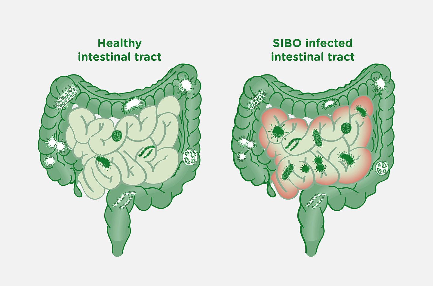 Sobrecrecimiento bacteriano tratamiento natural